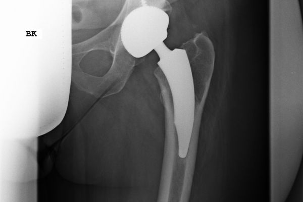 Röntgenbild einer Kurzschaftprothese