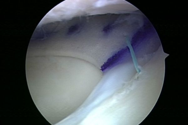 Meniskusimplantat nach Implantation ins Kniegelenk