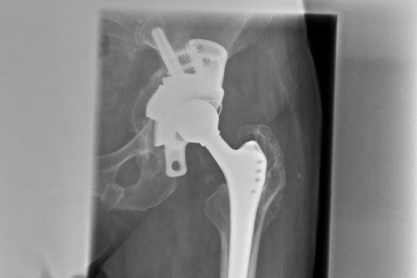 Röntgenbild eines individuellen Beckenteilersatzes