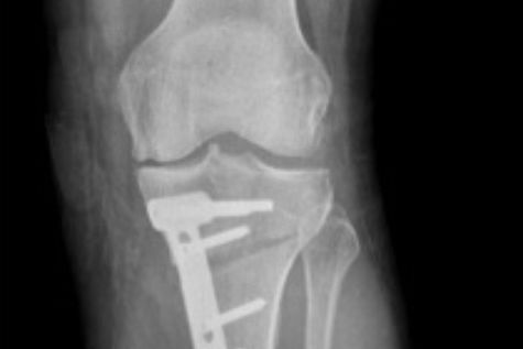 Kniegelenk nach operativer Korrektur einer O-Beinstellung