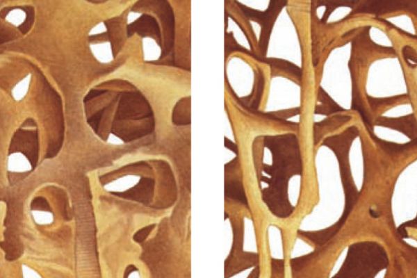 Knochenstrukturveränderung bei Osteoporose