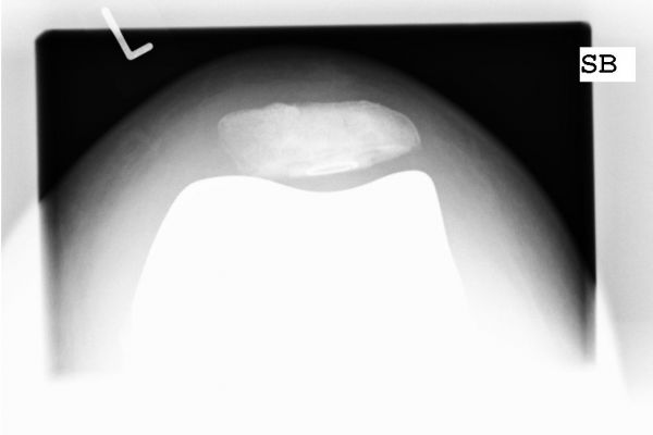 Röntgenbild eines Kniescheibenrückflächenersatzes