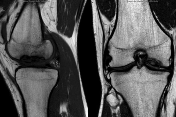 Kniegelenk mit sogenannter "Osteochondrosis dissecans"